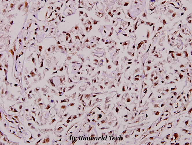 Immunohistochemistry (IHC) analyzes of TCF-1 (F26) pAb in paraffin-embedded human breast carcinoma tissue at 1:100.