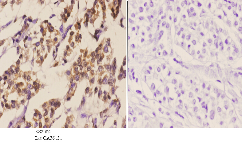 Immunohistochemistry (IHC) analyzes of C/EBP-δ/ε (A217) pAb in paraffin-embedded human liver carcinoma tissue at 1:50.showing cytoplasmic and nucleus staining. Negative control (the right)Using PBS instead of primary antibody, secondary antibody is Goat A