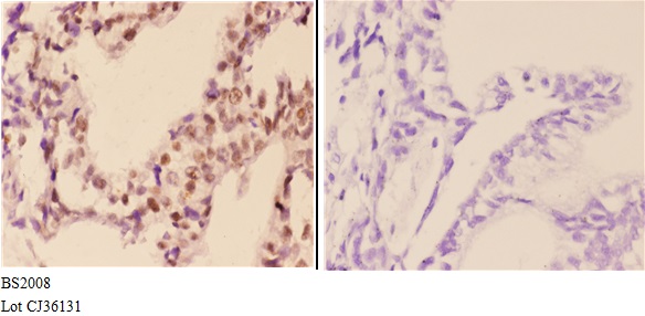 Immunohistochemistry (IHC) analyzes of FXR2 (E576) pAb in paraffin-embedded human colon carcinoma tissue at 1:50,showing cytoplasmic and nuclear staining.Negative control (the right)Using PBS instead of primary antibody, secondary antibody is Goat Anti-Rabbit IgG-biotin followed by avidin-peroxidase.