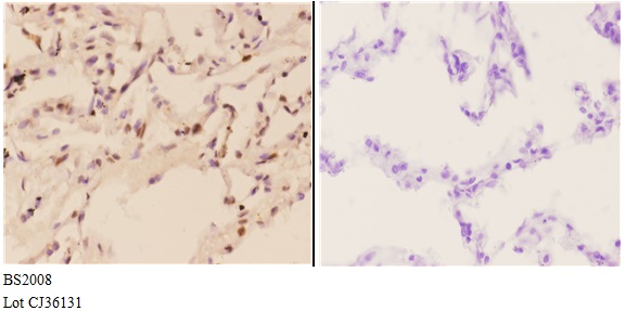 Immunohistochemistry (IHC) analyzes of FXR2 (E576) pAb in paraffin-embedded human lung carcinoma tissue at 1:50,showing cytoplasmic and nuclear staining.Negative control (the right) Using PBS instead of primary antibody, secondary antibody is Goat Anti-Ra