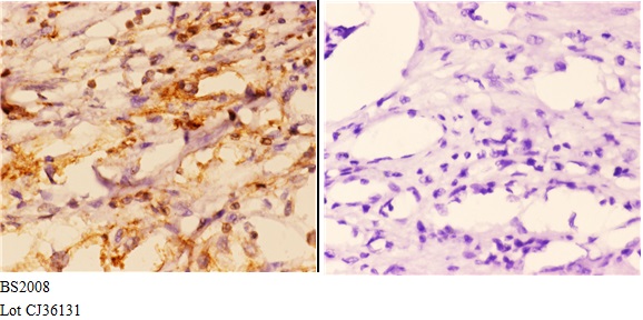 Immunohistochemistry (IHC) analyzes of FXR2 (E576) pAb in paraffin-embedded human kidney carcinoma tissue at 1:50,showing cytoplasmic and nuclear staining.Negative control (the right)Using PBS instead of primary antibody, secondary antibody is Goat Anti-R