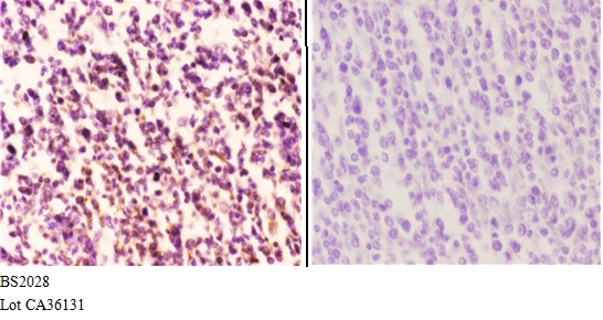 Immunohistochemistry (IHC) analyzes of MEF-2B (P98) pAb in paraffin-embedded tonsil carcinoma tissue at 1:50.showing Nucleus staining. Negative control (the right)Using PBS instead of primary antibody, secondary antibody is Goat Anti-Rabbit IgG-biotin followed by avidin-peroxidase.