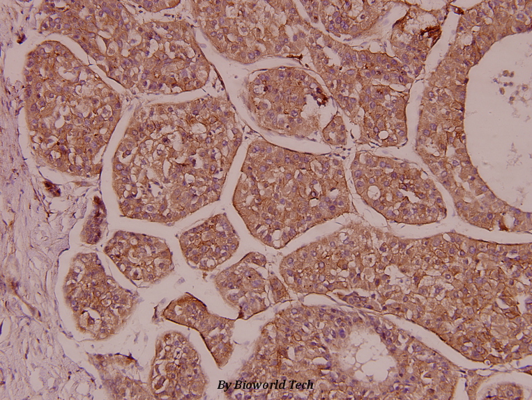 Immunohistochemistry (IHC) analyzes of CREM (I106) pAb in paraffin-embedded human liver carcinoma tissue at 1:100.