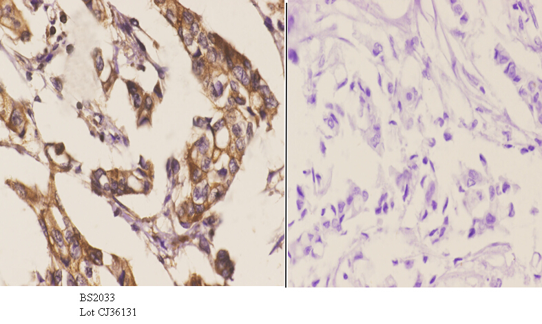 Immunohistochemistry (IHC) analyzes of HSF2 (R432) pAb in paraffin-embedded human breast carcinoma tissue at 1:50.showing cytoplasmic and nucleus staining. Negative control (the right)Using PBS instead of primary antibody, secondary antibody is Goat Anti-Rabbit IgG-biotin followed by avidin-peroxidase.