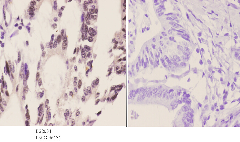 Immunohistochemistry (IHC) analyzes of TLE2 (K214) pAb in paraffin-embedded human colon carcinoma tissue at 1:50.showing nucleus staining. Negative control (the right)Using PBS instead of primary antibody, secondary antibody is Goat Anti-Rabbit IgG-biotin followed by avidin-peroxidase.