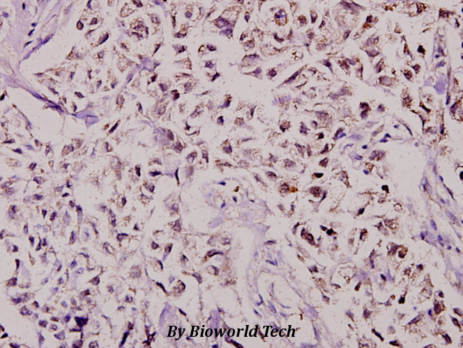 Immunohistochemistry (IHC) analyzes of CBP80 (R5) pAb in paraffin-embedded human breast carcinoma tissue at 1:100.