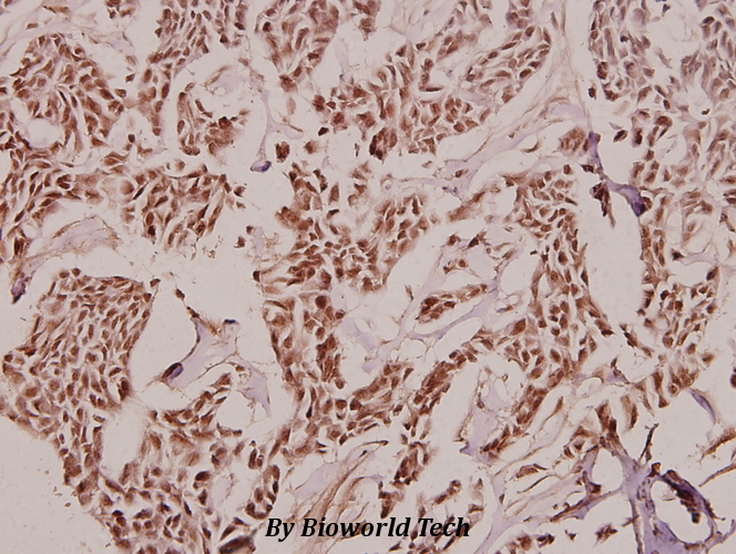 Immunohistochemistry (IHC) analyzes of Treacle (Q55) pAb in paraffin-embedded human breast carcinoma tissue at 1:100.