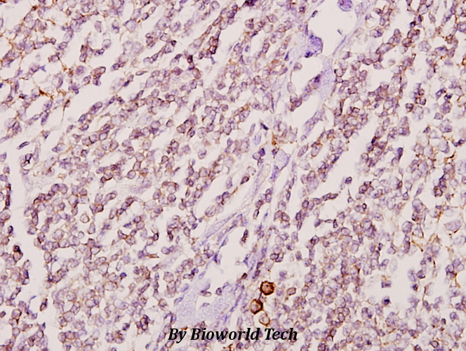 Immunohistochemistry (IHC) analyzes of GK2 (Y306) pAb in paraffin-embedded human tonsil cancer tissue at 1:50.
