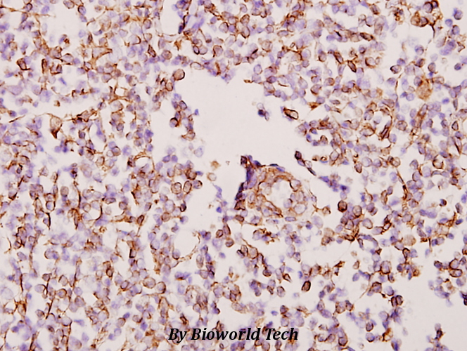 Immunohistochemistry (IHC) analyzes of WTAP (H351) pAb in paraffin-embedded human tonsil cancer tissue at 1:50.
