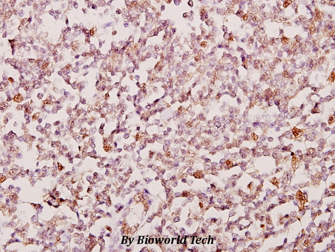 Immunohistochemistry (IHC) analyzes of PSMD2 (R34) pAb in paraffin-embedded human tonsil cancer tissue at 1:50.