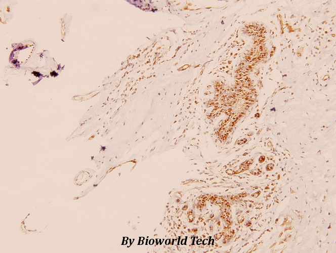 Immunohistochemistry (IHC) analyzes of TRAP220 (P697) pAb in paraffin-embedded human breast carcinoma tissue at 1:100.