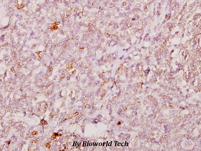Immunohistochemistry (IHC) analyzes of FoxJ1 (T295) pAb in paraffin-embedded human tonsil cancer tissue at 1:50.