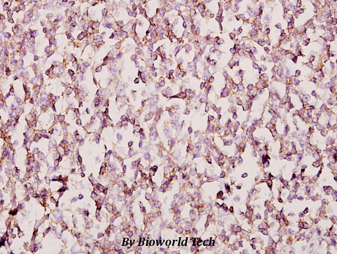 Immunohistochemistry (IHC) analyzes of FoxB1/2 (I72) pAb in paraffin-embedded human tonsil cancer tissue at 1:50.