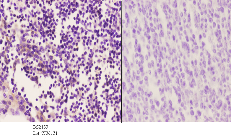 Immunohistochemistry (IHC) analyzes of Mnk1 (I136) pAb in paraffin-embedded human tonsil carcinoma tissue at 1:50.showing cytoplasmic and nucleus staining. Negative control (the right)Using PBS instead of primary antibody, secondary antibody is Goat Anti-Rabbit IgG-biotin followed by avidin-peroxidase.
