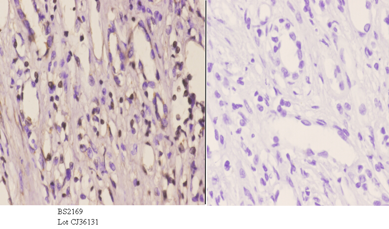 Immunohistochemistry (IHC) analyzes of MSY2 (G311) pAb in paraffin-embedded human kidney carcinoma tissue at 1:50.showing cytoplasmic and nucleus staining. Negative control (the right)Using PBS instead of primary antibody, secondary antibody is Goat Anti-Rabbit IgG-biotin followed by avidin-peroxidase.