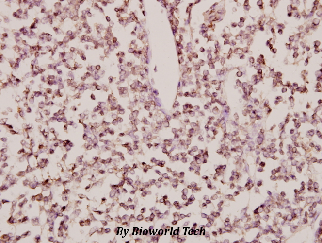 Immunohistochemistry (IHC) analyzes of CYP24A1 (R439) pAb in paraffin-embedded human tonsil carcinoma tissue at 1:50.