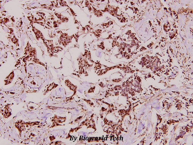 Immunohistochemistry (IHC) analyzes of CYP27A1 (E131) pAb in paraffin-embedded human breast carcinoma tissue at 1:100.