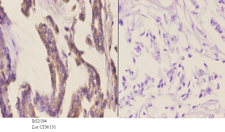 Immunohistochemistry (IHC) analyzes of CYP2A13 (N338) pAb in paraffin-embedded human breast carcinoma tissue at 1:50.showing cytoplasmic staining. Negative control (the right)Using PBS instead of primary antibody, secondary antibody is Goat Anti-Rabbit IgG-biotin followed by avidin-peroxidase.