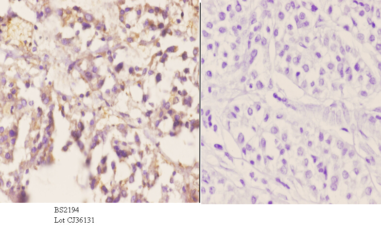 Immunohistochemistry (IHC) analyzes of CYP2A13 (N338) pAb in paraffin-embedded human liver carcinoma tissue at 1:50.showing cytoplasmic staining. Negative control (the right)Using PBS instead of primary antibody, secondary antibody is Goat Anti-Rabbit IgG