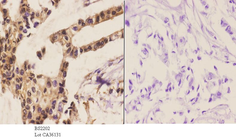 Immunohistochemistry (IHC) analyzes of Cdc16 (E206) pAb in paraffin-embedded human breast carcinoma tissue at 1:50.showing cytoplasmic and nucleus staining. Negative control (the right)Using PBS instead of primary antibody, secondary antibody is Goat Anti-Rabbit IgG-biotin followed by avidin-peroxidase.