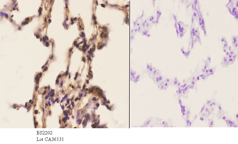 Immunohistochemistry (IHC) analyzes of Cdc16 (E206) pAb in paraffin-embedded human lung carcinoma tissue at 1:50.showing cytoplasmic and nucleus staining. Negative control (the right)Using PBS instead of primary antibody, secondary antibody is Goat Anti-R