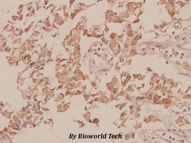 Immunohistochemistry (IHC) analyzes of M-cadherin (A108) pAb in paraffin-embedded human breast carcinoma tissue at 1:50.