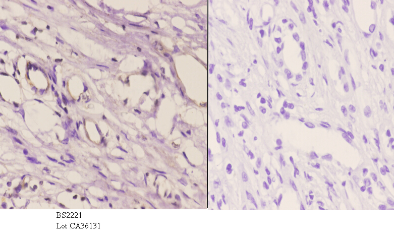 Immunohistochemistry (IHC) analyzes of Cadherin-16 (M810) pAb in paraffin-embedded human kidney carcinoma tissue at 1:50.showing cell membrane staining. Negative control (the right)Using PBS instead of primary antibody, secondary antibody is Goat Anti-Rabbit IgG-biotin followed by avidin-peroxidase.