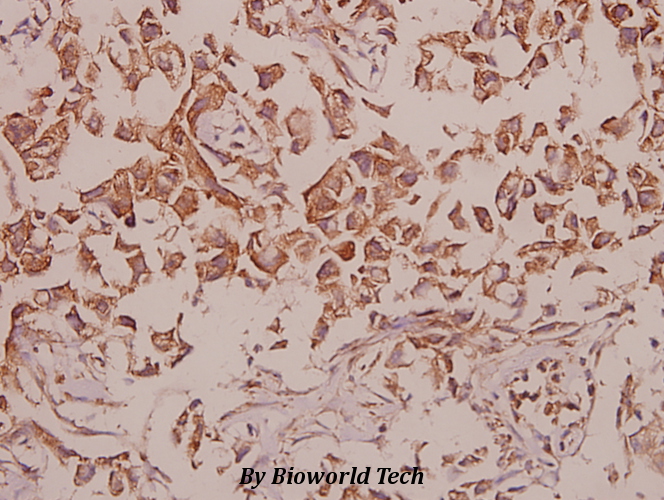 Immunohistochemistry (IHC) analyzes of Cadherin-18 (Q129) pAb in paraffin-embedded human colorectal carcinoma tissue at 1:50.