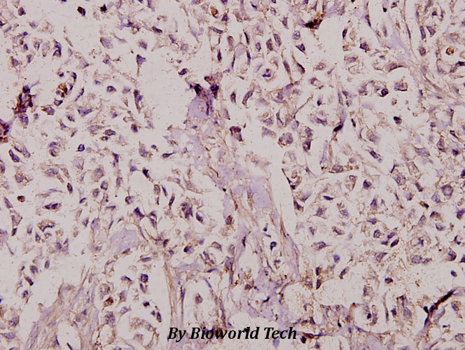 Immunohistochemistry (IHC) analyzes of TAF II p135/p105 (E977) pAb in paraffin-embedded human breast carcinoma tissue at 1:100.