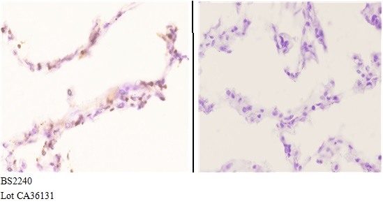 Immunohistochemistry (IHC) analyzes of FoxE1 (Q11) pAb in paraffin-embedded lung carcinoma tissue at 1:50 showing Nucleus staining. Negative control (the right)Using PBS instead of primary antibody, secondary antibody is Goat Anti-Rabbit IgG-biotin followed by avidin-peroxidase.