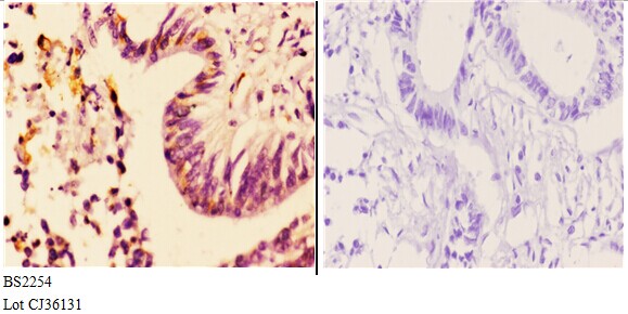 Immunohistochemistry (IHC) analyzes of AR-α2A (R361) pAb in paraffin-embedded human rectum carcinoma tissue at 1:50.showing Nuclear staining. Negative control (the right)Using PBS instead of primary antibody, secondary antibody is Goat Anti-Rabbit IgG-biotin followed by avidin-peroxidase.