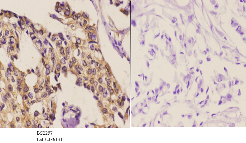 Immunohistochemistry (IHC) analyzes of SnoN (D652) pAb in paraffin-embedded human breast carcinoma tissue at 1:50.showing cytoplasmic and nucleus staining. Negative control (the right)Using PBS instead of primary antibody, secondary antibody is Goat Anti-Rabbit IgG-biotin followed by avidin-peroxidase.