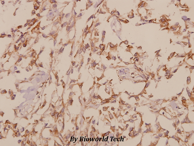 Immunohistochemistry (IHC) analyzes of TFIIH p62 (A32) pAb in paraffin-embedded human breast carcinoma tissue at 1:50.