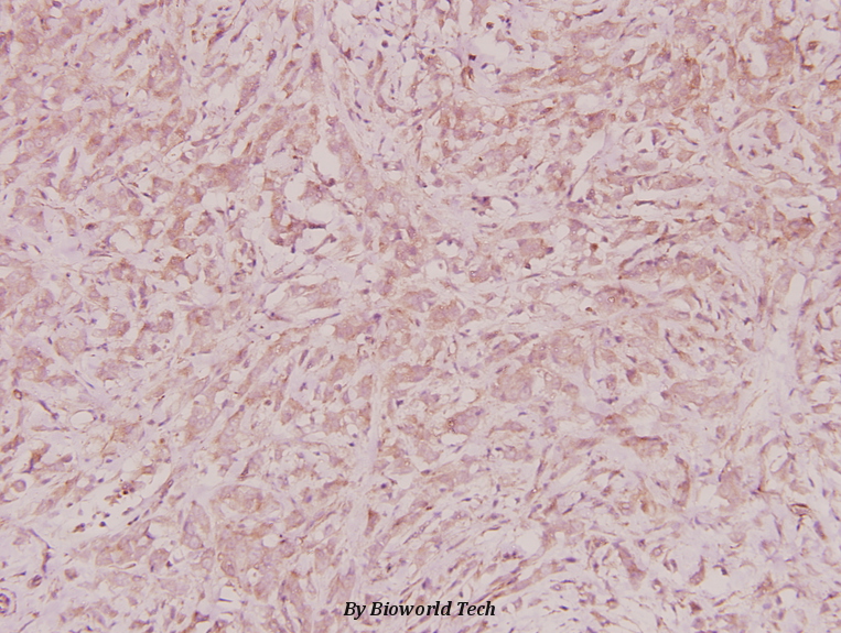 Immunohistochemistry (IHC) analyzes of ZNF134 (K72) pAb in paraffin-embedded human breast carcinoma tissue at 1:100.