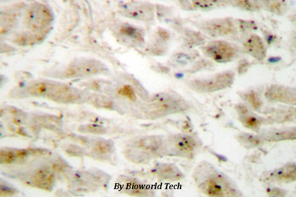 Immunohistochemistry (IHC) analyzes of LIMK2 (K491) pAb in paraffin-embedded human breast carcinoma tissue at 1:50.showing nucleus/cell membrane and cytoplasmic staining. Negative control (the right)Using PBS instead of primary antibody, secondary antibody is Goat Anti-Rabbit IgG-biotin followed by avidin-peroxidase.