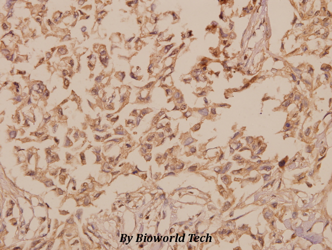 Immunohistochemistry (IHC) analyzes of hnRNP H (R192) pAb in paraffin-embedded human breast carcinoma tissue at 1:50.