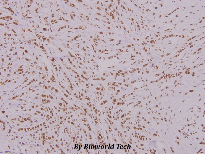 Immunohistochemistry (IHC) analyzes of FoxK1 (G698) pAb in paraffin-embedded human breast carcinoma tissue at 1:100.