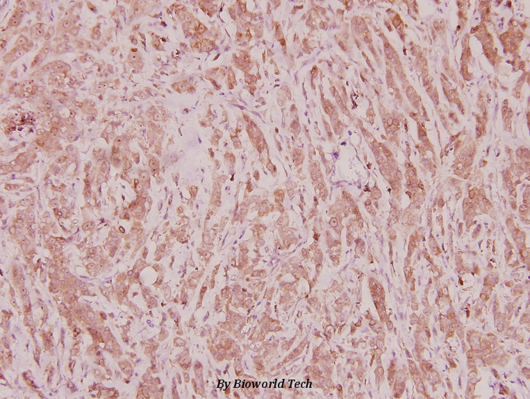 Immunohistochemistry (IHC) analyzes of C/EBP ζ (D24) pAb in paraffin-embedded human breast carcinoma tissue at 1:100.