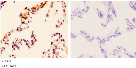 Immunohistochemistry (IHC) analyzes of FoxL1 (G150) pAb in paraffin-embedded human lung carcinoma tissue at 1:50.showing Cytoplasm and Nuclear staining. Negative control (the right)Using PBS instead of primary antibody, secondary antibody is Goat Anti-Rabbit IgG-biotin followed by avidin-peroxidase.