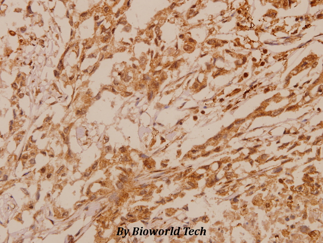 Immunohistochemistry (IHC) analyzes of MKP-2 (Y108) pAb in paraffin-embedded human breast carcinoma tissue at 1:50.