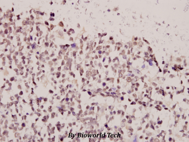 Immunohistochemistry (IHC) analyzes of FoxE3 (R97) pAb in paraffin-embedded human tonsil carcinoma tissue at 1:50.