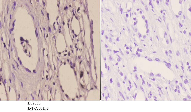 Immunohistochemistry (IHC) analyzes of TFIIH p44 (T18) pAb in paraffin-embedded human kidney carcinoma tissue at 1:50.showing nucleus staining. Negative control (the right)Using PBS instead of primary antibody, secondary antibody is Goat Anti-Rabbit IgG-biotin followed by avidin-peroxidase.