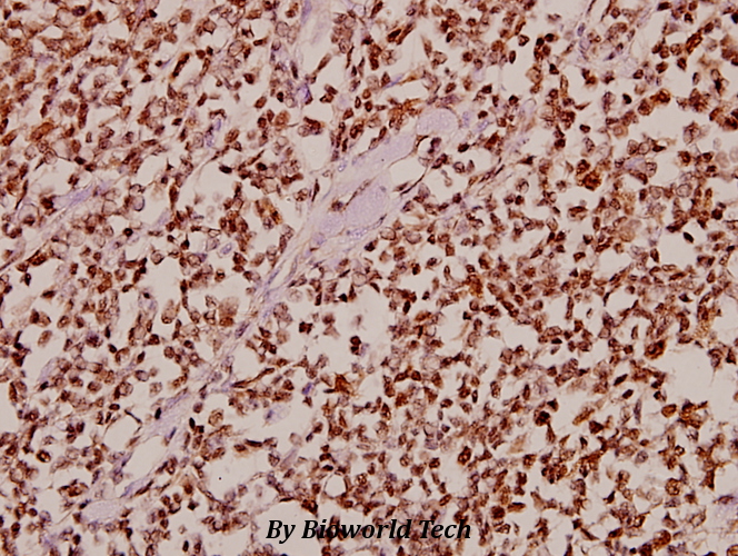 Immunohistochemistry (IHC) analyzes of CDK10 (E63) pAb in paraffin-embedded human tonsil carcinoma tissue at 1:50.