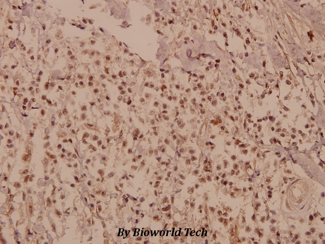 Immunohistochemistry (IHC) analyzes of CUG-BP1/2 (K95) pAb in paraffin-embedded human breast carcinoma tissue at 1:50.