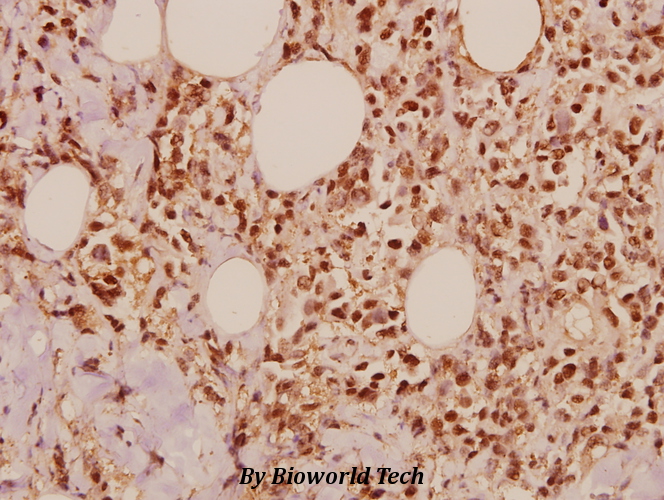 Immunohistochemistry (IHC) analyzes of COPS5 / JAB1 (K191) pAb in paraffin-embedded human breast carcinoma tissue at 1:50.