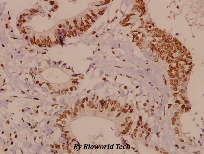 Immunohistochemistry (IHC) analyzes of HES-6 (A6) pAb in paraffin-embedded human colorectal carcinoma tissue at 1:50.