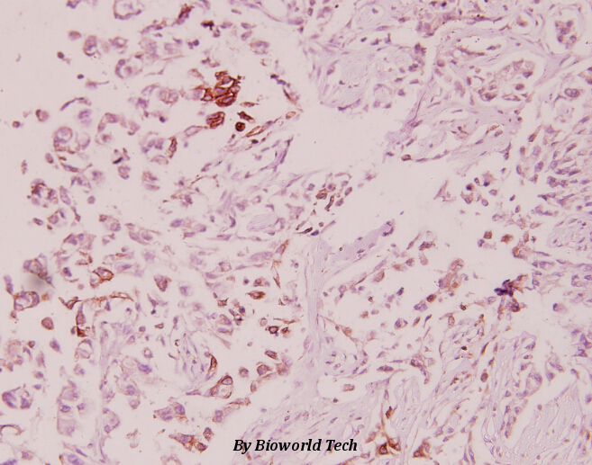 Immunohistochemistry (IHC) analyzes of ILKAP (K71) pAb in paraffin-embedded human breast carcinoma tissue at 1:100.