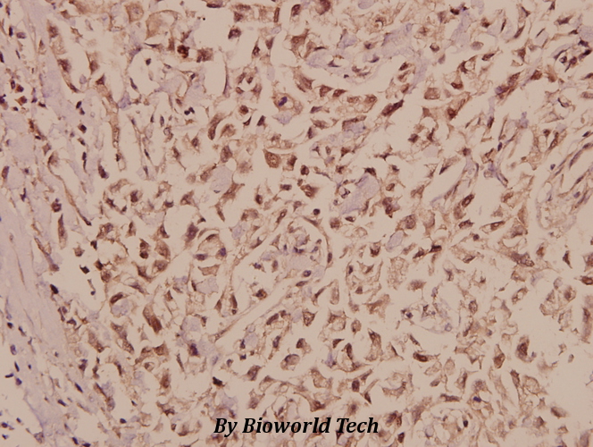 Immunohistochemistry (IHC) analyzes of CRSP77 (V171) pAb in paraffin-embedded human breast carcinoma tissue at 1:50.