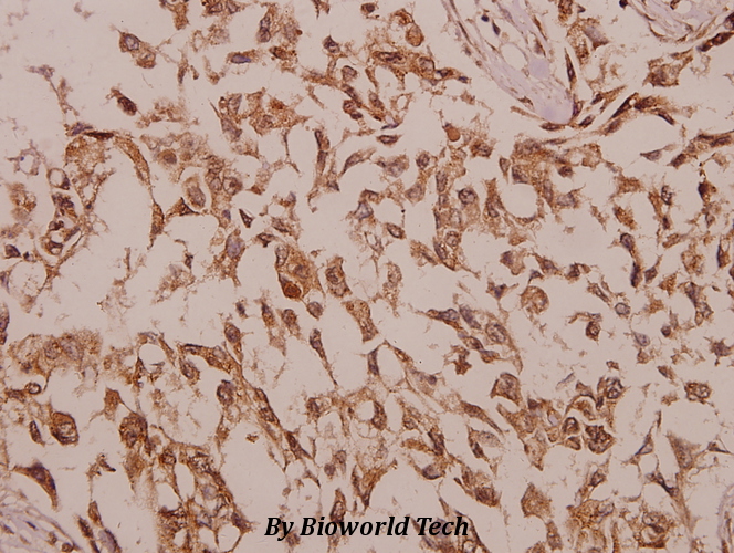 Immunohistochemistry (IHC) analyzes of ChoKB (E324) pAb in paraffin-embedded human colorectal carcinoma tissue at 1:50.