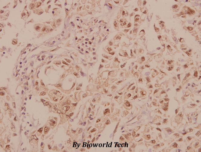 Immunohistochemistry (IHC) analyzes of MRCKβ (F1665) pAb in paraffin-embedded human breast carcinoma tissue at 1:50.